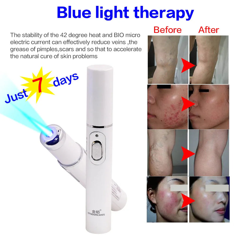 Máquina de luz azul para o rosto,Remoção de rugas da acne Caneta a laser Remoção de manchas da pele Anti-varizes ,Tratamento médico.